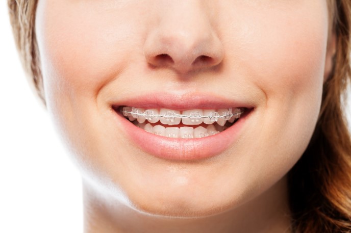 брекеты керамические или металлические цена