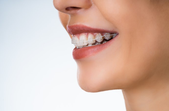 плюсы и минусы металлических брекетов
